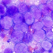 リンパ腫 細胞診