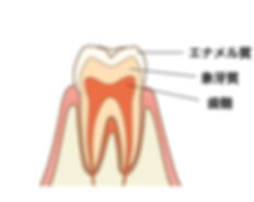 むし歯治療