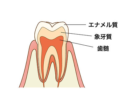 むし歯治療