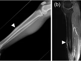 Nutrition Management of Bone Stress Injuries