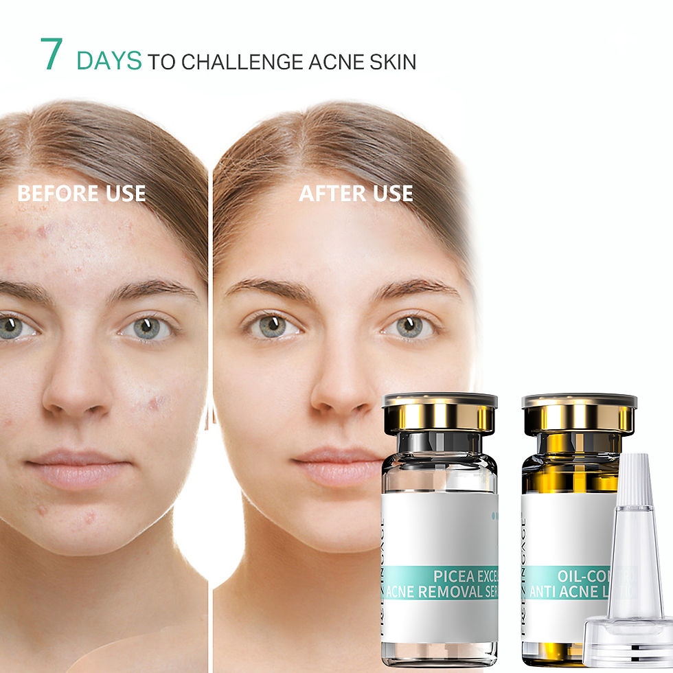 Thumbnail: PICEA EXCELSA INTENSIVE       ACNE KIT