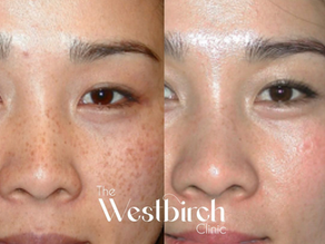 Restoring Brighter, Clearer Skin, Naturally