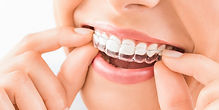 invisalign.jpeg