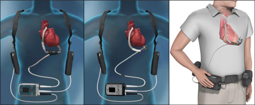 10 Best LVAD Accessories for Safety and Style