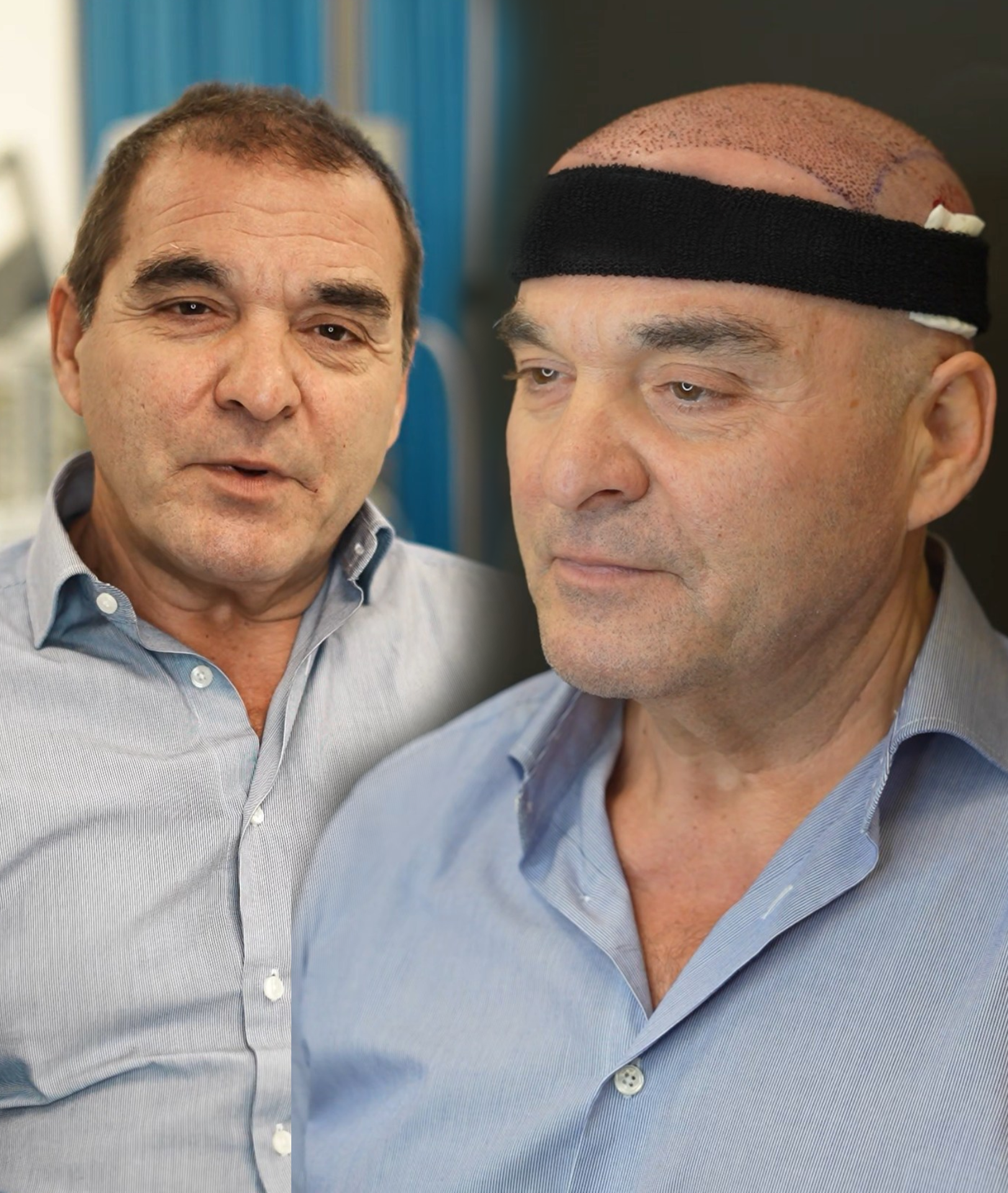 השתלת שיער 11