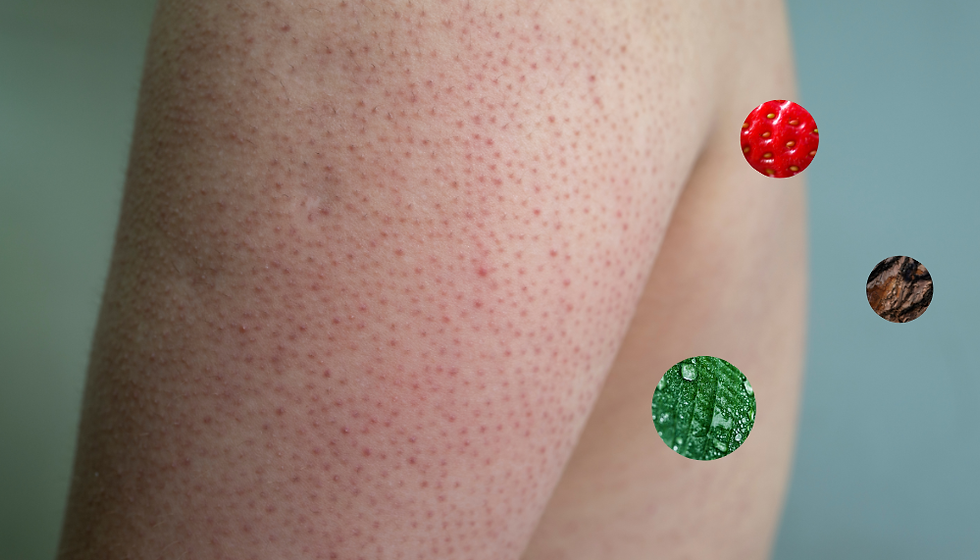 Keratosis Pilaris: More Than Just Rough Skin