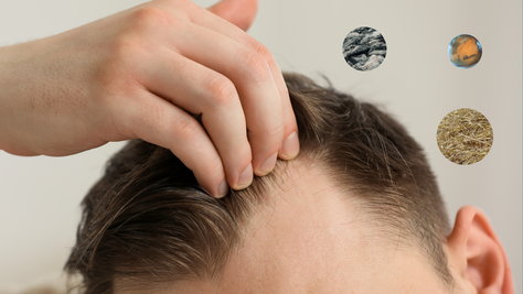 Why Male Pattern Baldness Is More Than Just Hair Loss