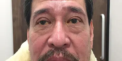 After_眉毛下皮膚切除2.webp
