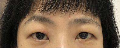 Before_切開法.jpg