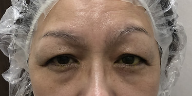 Before_眉下リフト.jpg