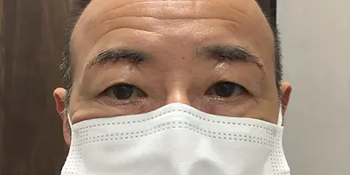 After_眉毛下皮膚切除3.webp