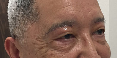 After_眉毛下皮膚切除術.jpg