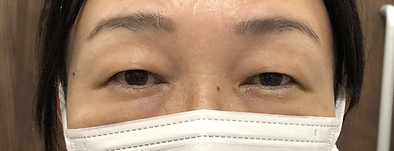 Before_経結膜ミューラー筋タッキング手術.jpg