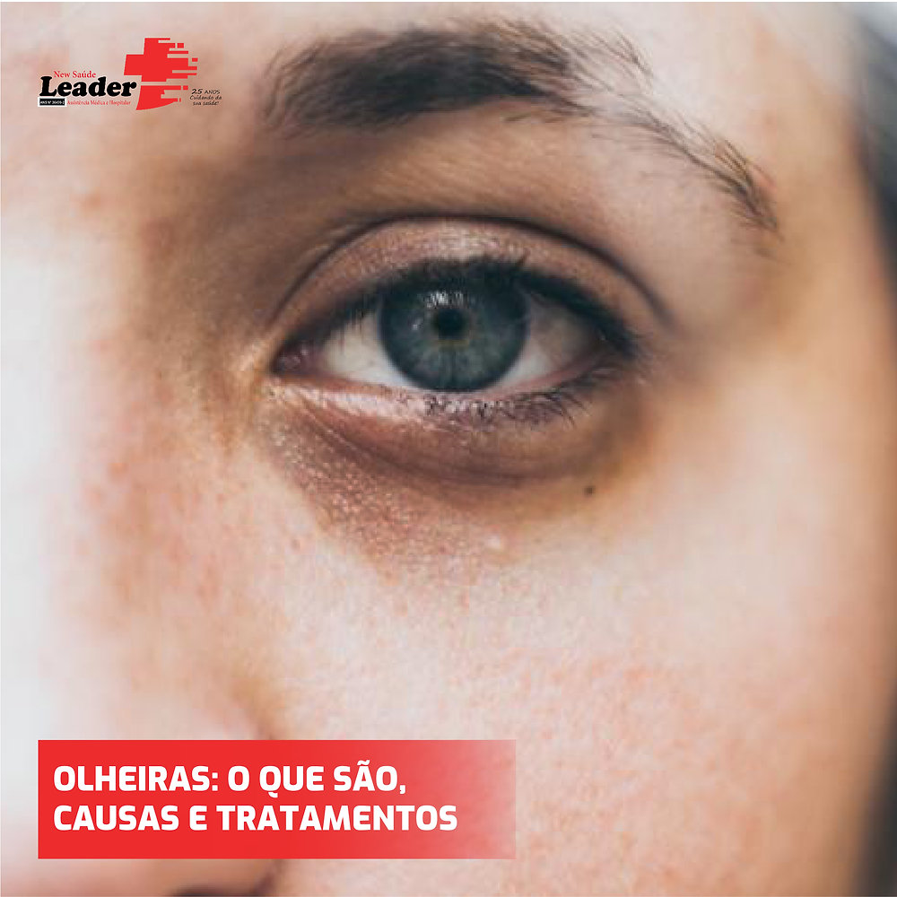 Olheiras: O que são? Causas e tratamentos