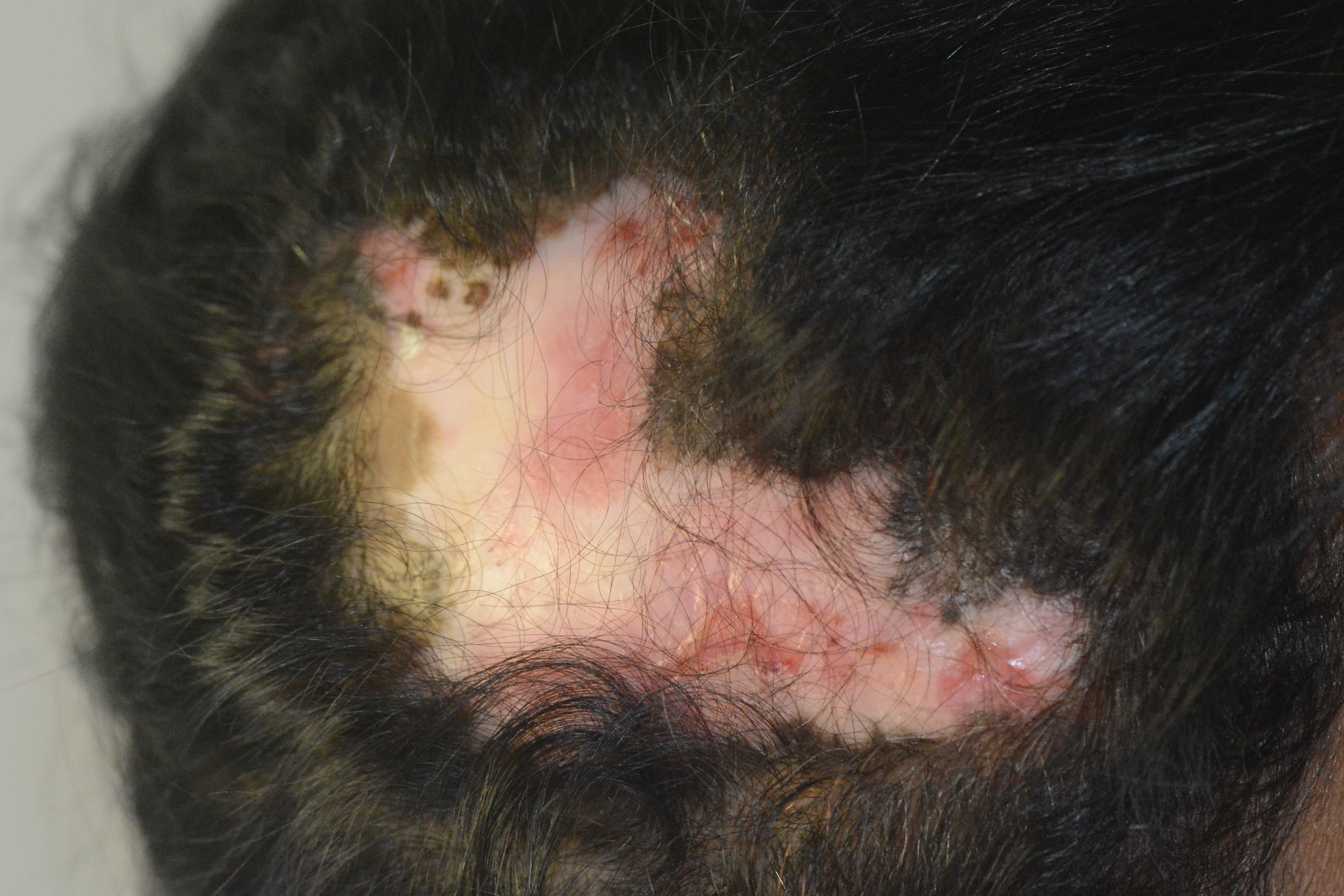 Discoid lupus erythematosus