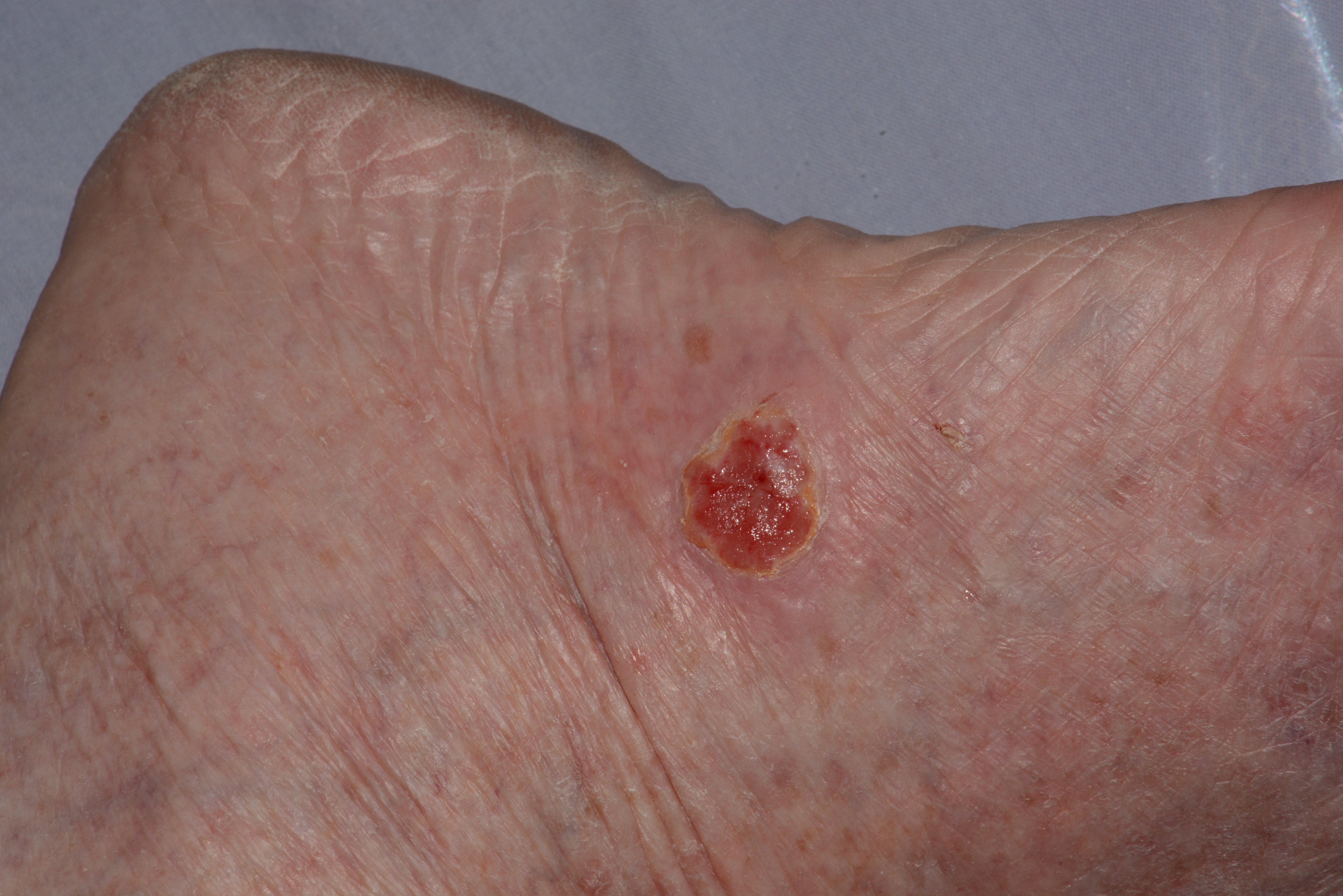 Basal Cell Carcinoma Dr N Raboobee dermatologist Westville