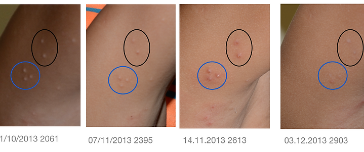 Aldara molluscum contagiosum
