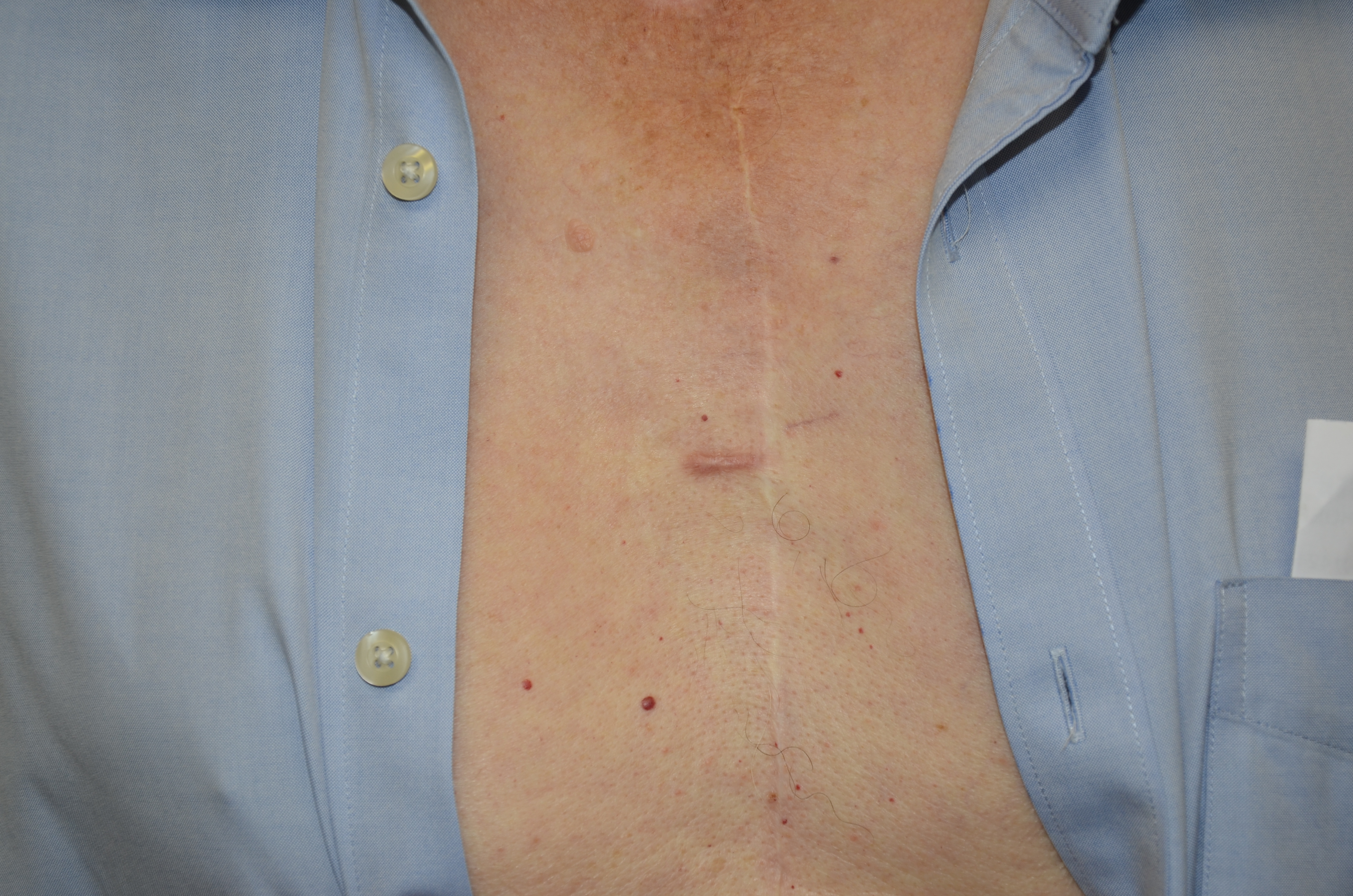 Keloids drnraboobee1