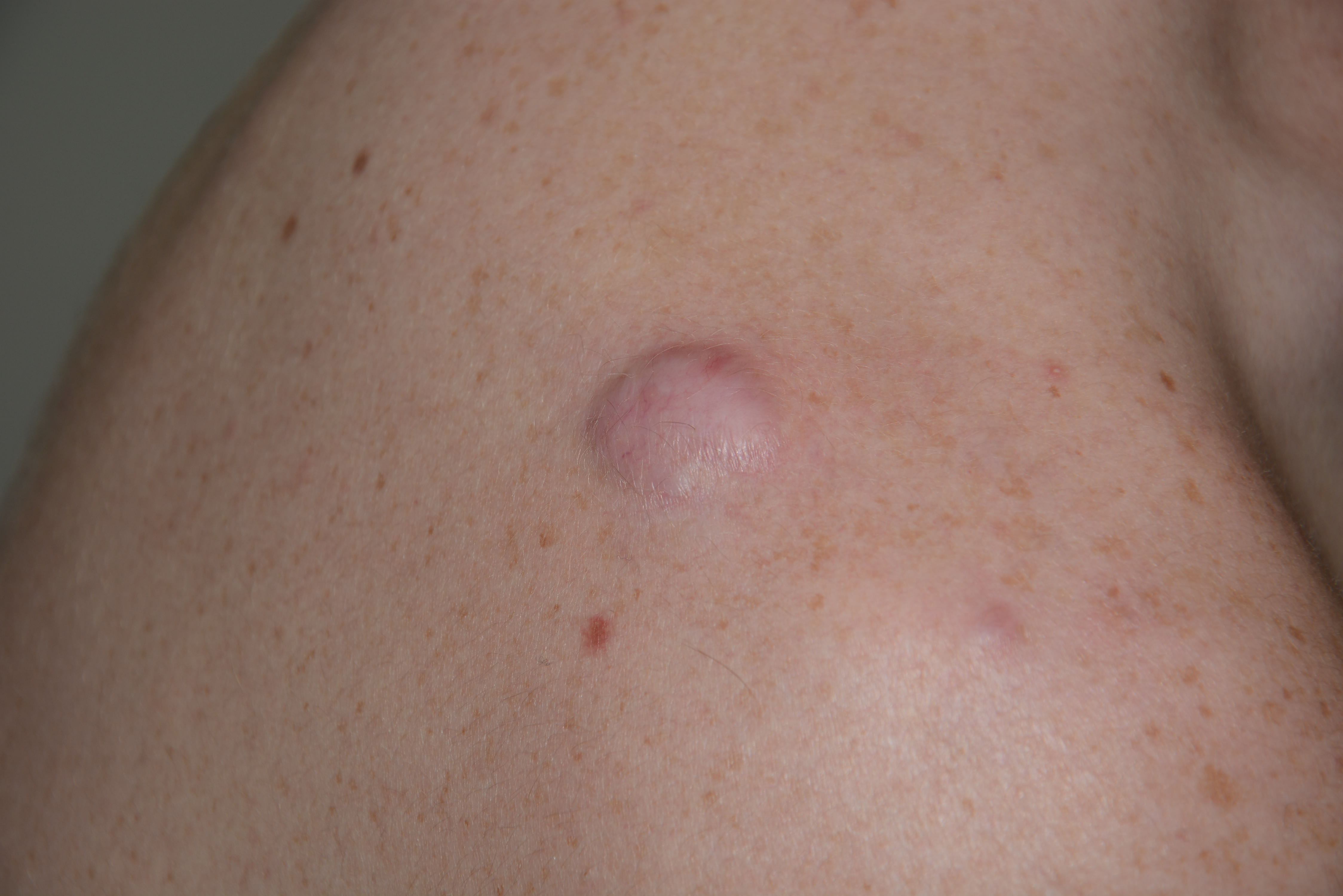 Liquid nitrogen drnraboobee1