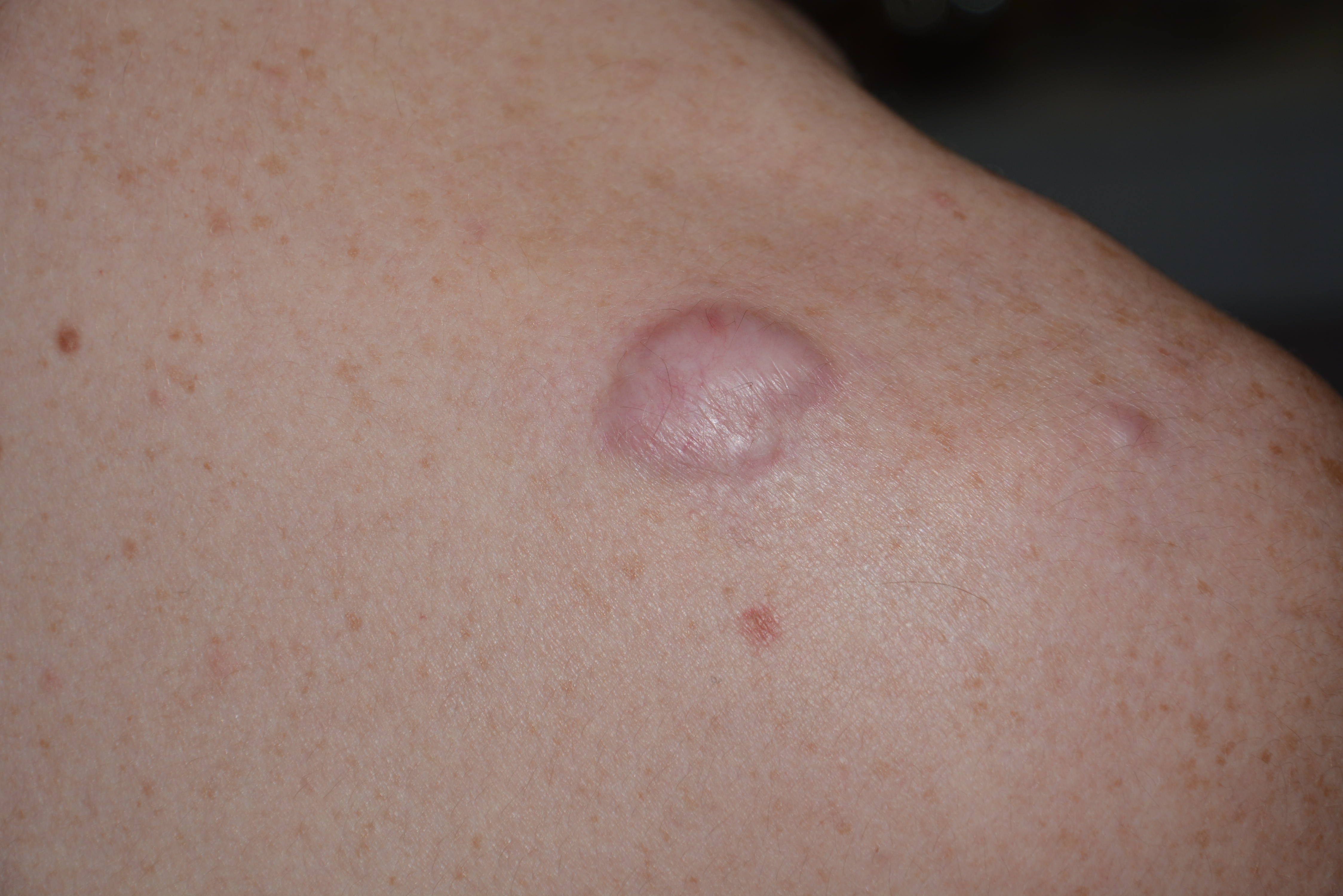 Keloids drnraboobee1