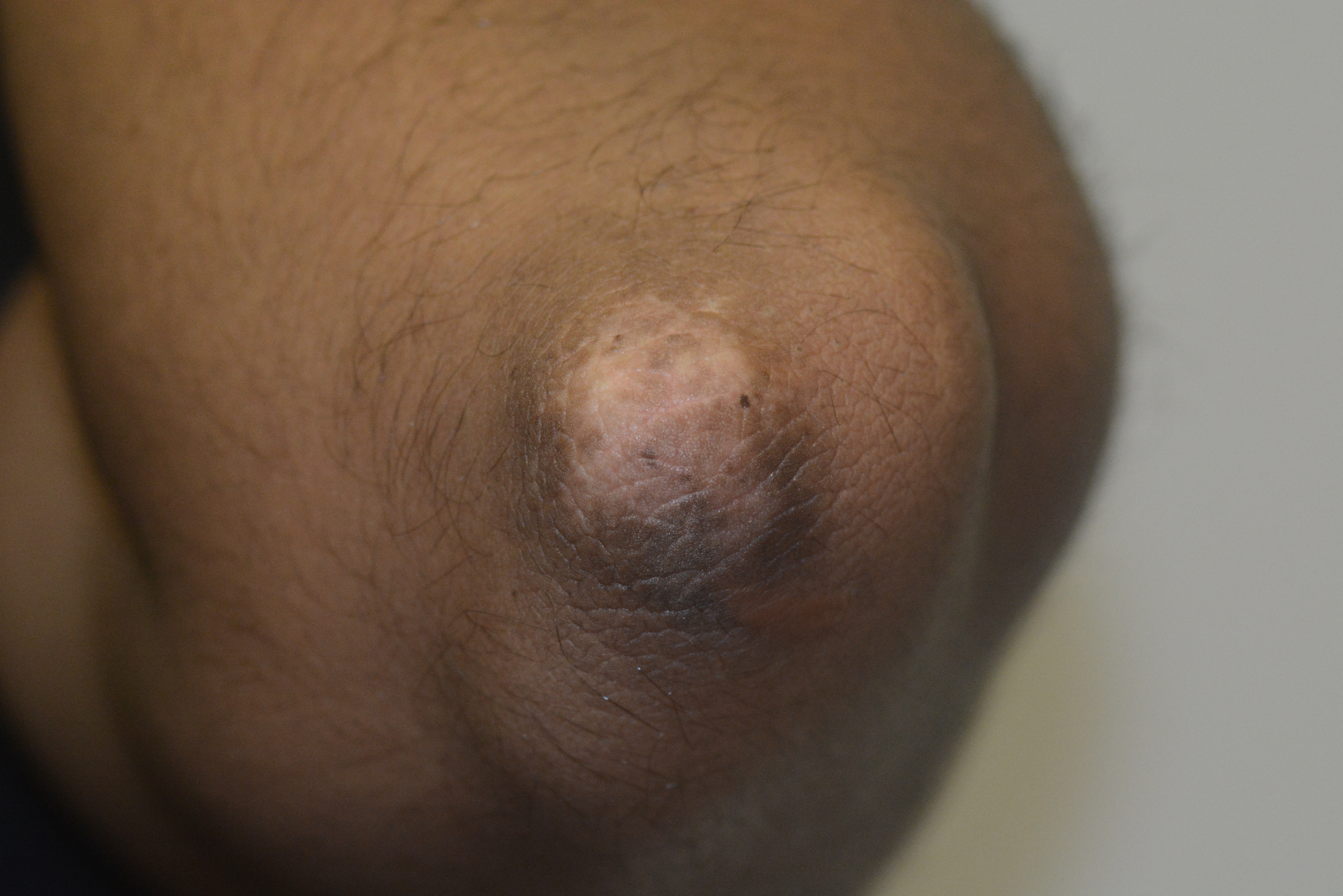 Post inflammatory hypopigmentation