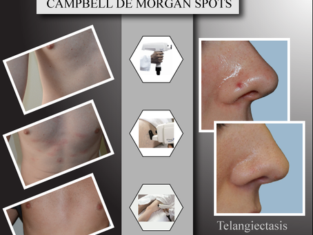 NdYAG laser for Campbell de Morgan Spots