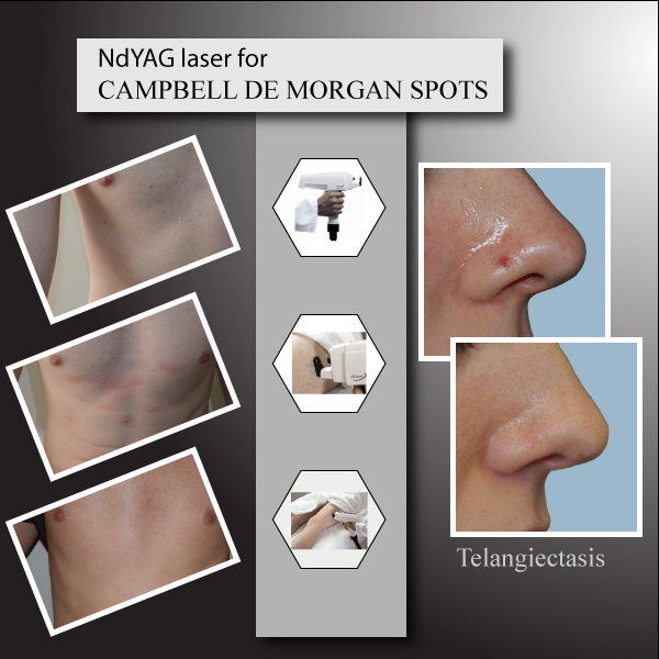 NdYAG laser for Telangiectasia