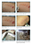 Vitiligo study suction blister grafting