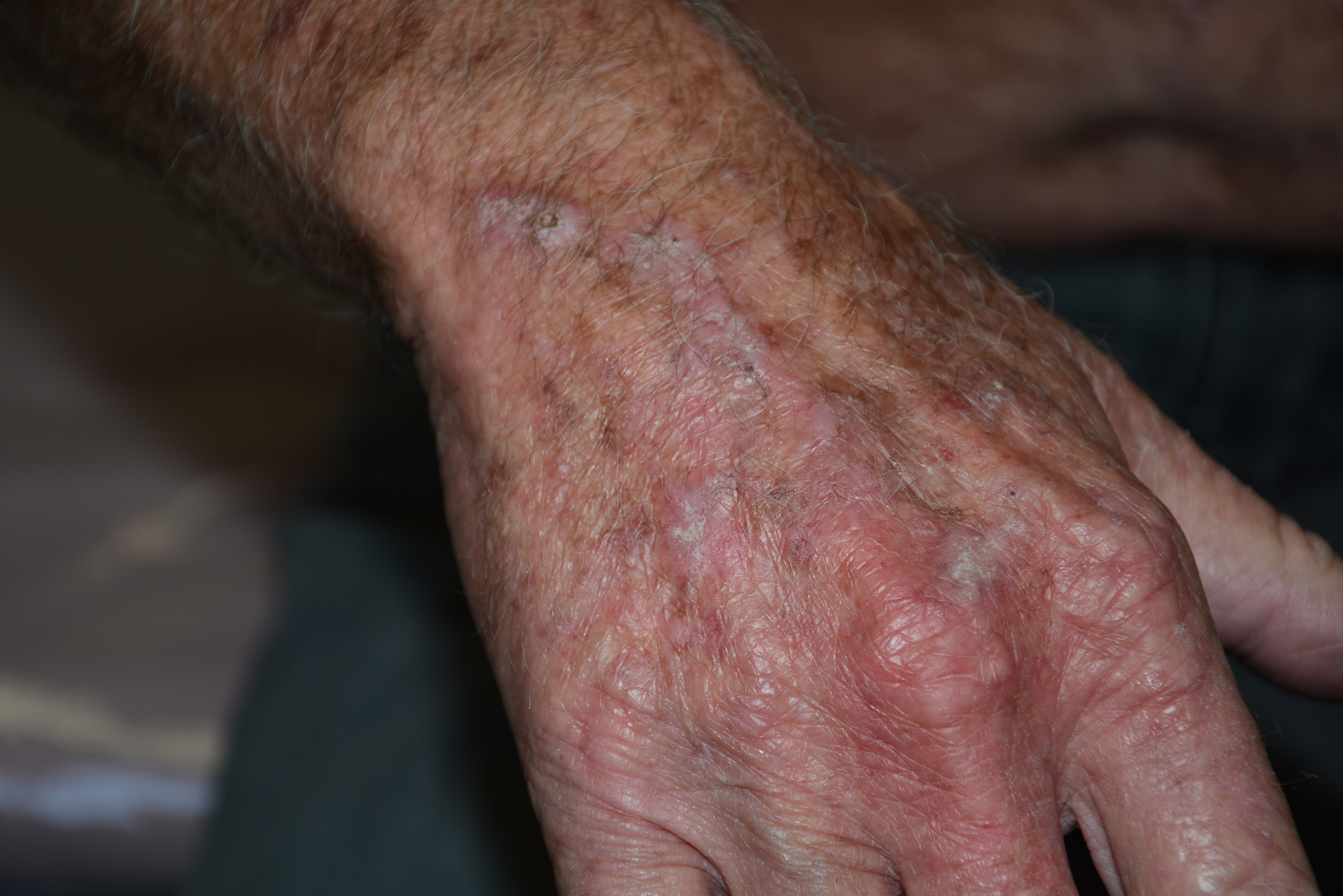 Liquid nitrogen drnraboobee1