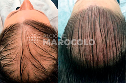 microcapilar-antes-depois2