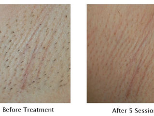 Clarity II laser – avancerad laser för hårborttagning & hud