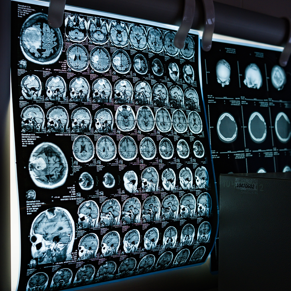 Ainda faz sentido falar sobre epilepsia?