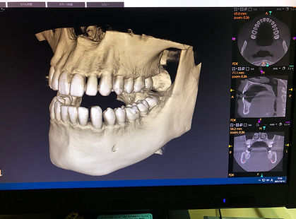 歯科用CT3次元写真