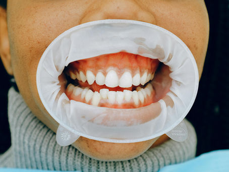Why Your Gums Bleed: Common Causes and Effective Solutions