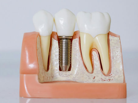 Everything You Need to Know About Dental Implants: Costs, Benefits, and Procedure