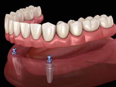Revive Your Smile: Dental Implant Options Explained