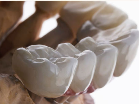 Are Dental Crowns Worth the Cost? Pros, Cons, and Alternatives