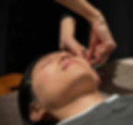 顔鍼施術