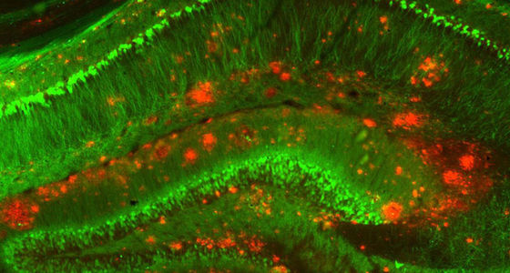 Alzheimer’s protein can travel from blood to build up in the brain