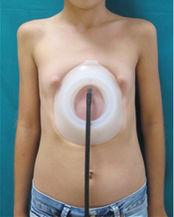 An Image of a Patient Who Underwent a Vacuum Bell Operation.jpeg