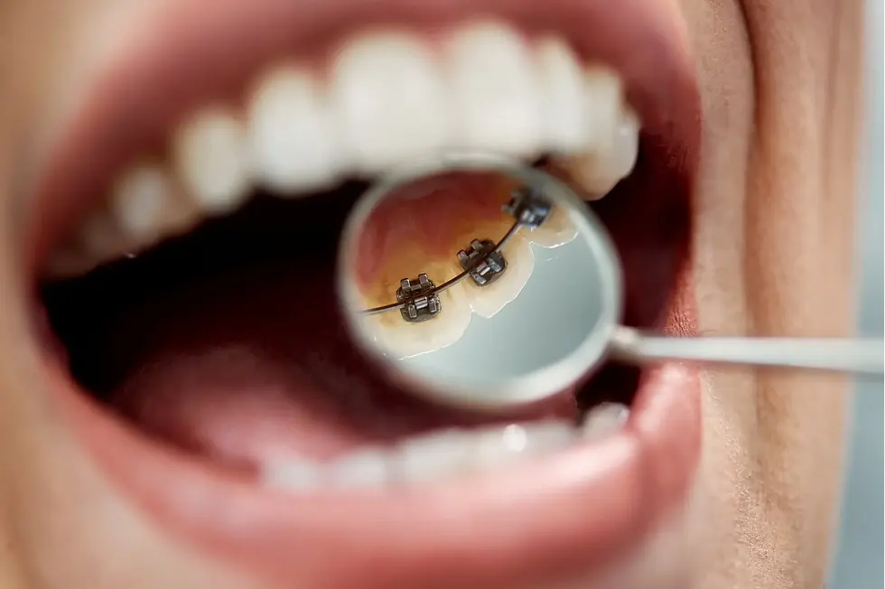 Metal Braces treatment in izmir turkey