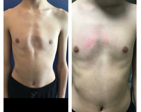 Pectus Arcuatum2.png