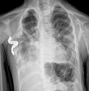 Lateral Thoracic Expansion Technique 2.JPG