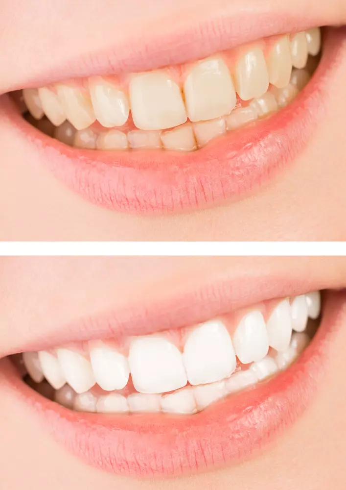 Teeth (Bleaching) Whitening in Izmir, Turkey Deva Dental Clinic