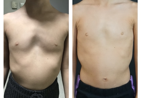 Pectus Arcuatum 6.png