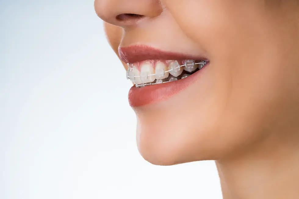 Metal Braces treatment in izmir turkey