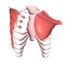 Poland Syndrome - Dr.Pectus