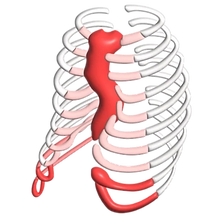 Rib Flare Accompany to Pectus Excavatum