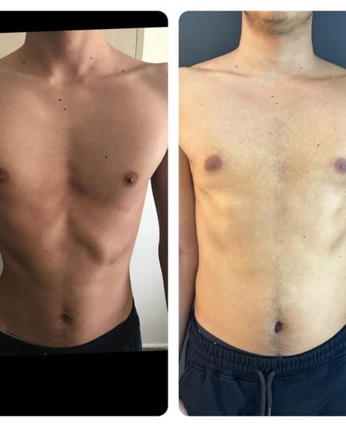 Pectus Surgery Izmir Turkey Before & After_30.jpeg