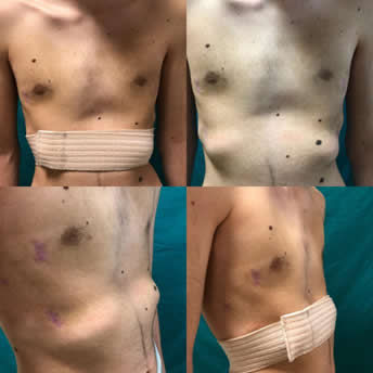 Rib Flare cases treated with bandage.jpeg